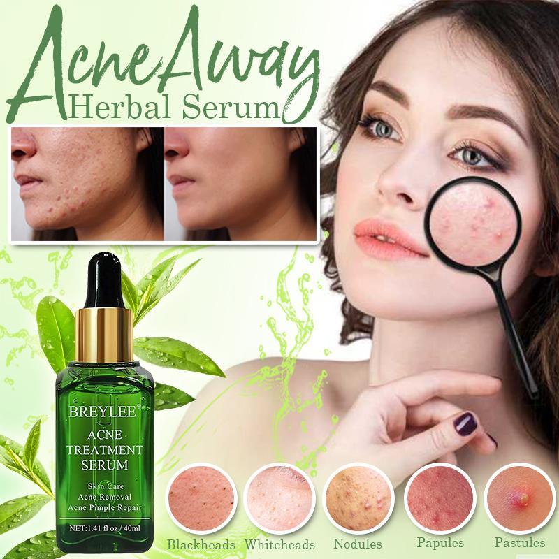 Acne Away Herbal Serum 17ml