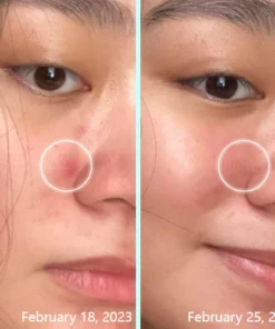 ACRÄN Hydrocolloid Face Patches