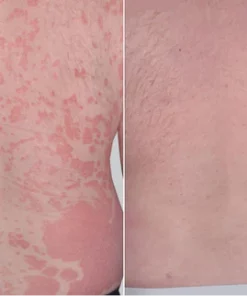 DermaCure Psoriasis Cream