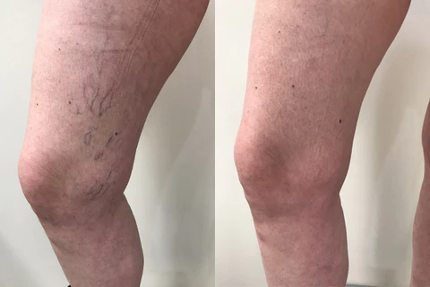 Oveallgo VeinHealing Varicose Veins Treatment Spray