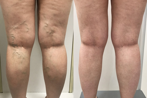 LymphCare VaricoseVeins Treatment Cream