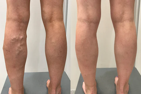 Oveallgo VeinHealing Varicose Veins Treatment Spray