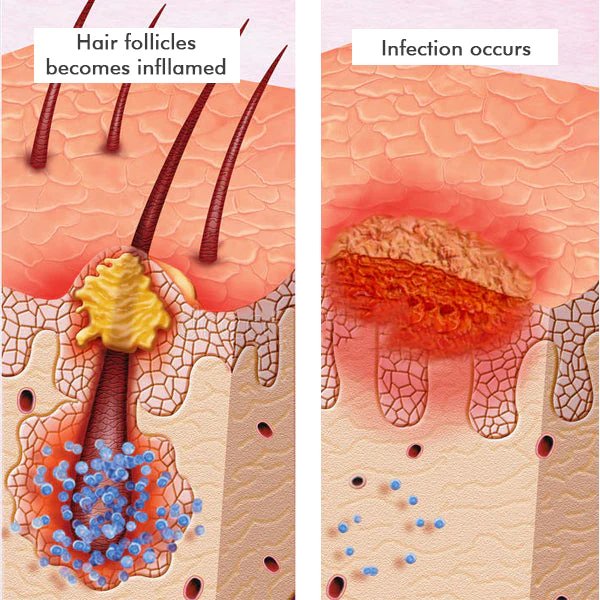 Dermax Folliculitis Clearing Spray