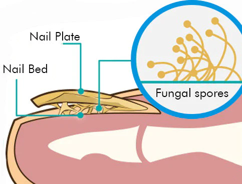 NailCure Fungi Treatment Pen