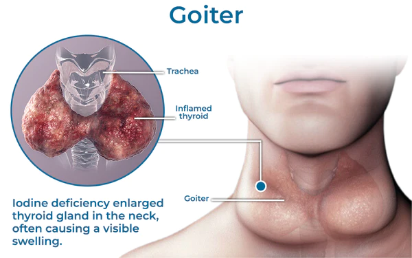 GFOUK Neck Goiter and Firming Therapy Serum