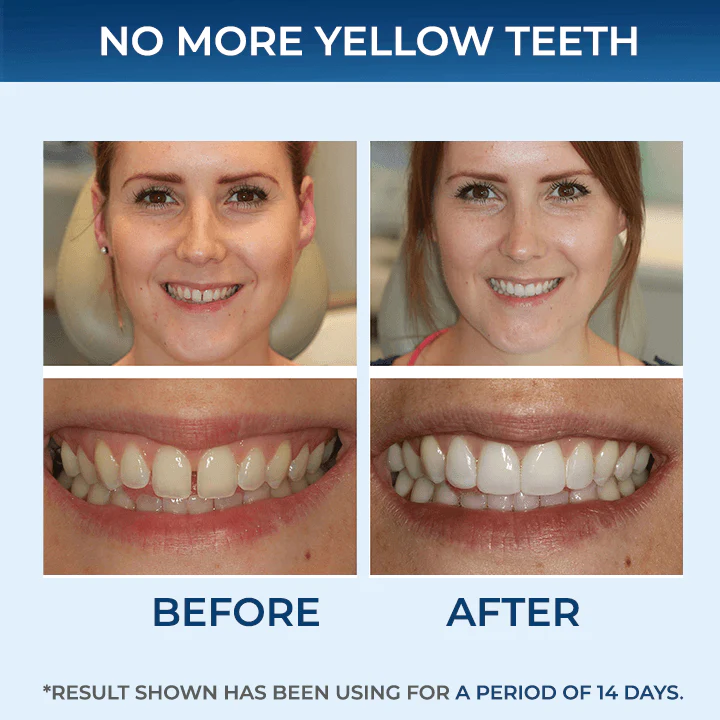 5D Teeth Whitening Strips