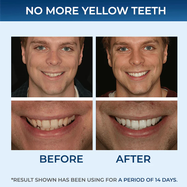 SMILEKITŽ 5D Teeth Whitening Strips