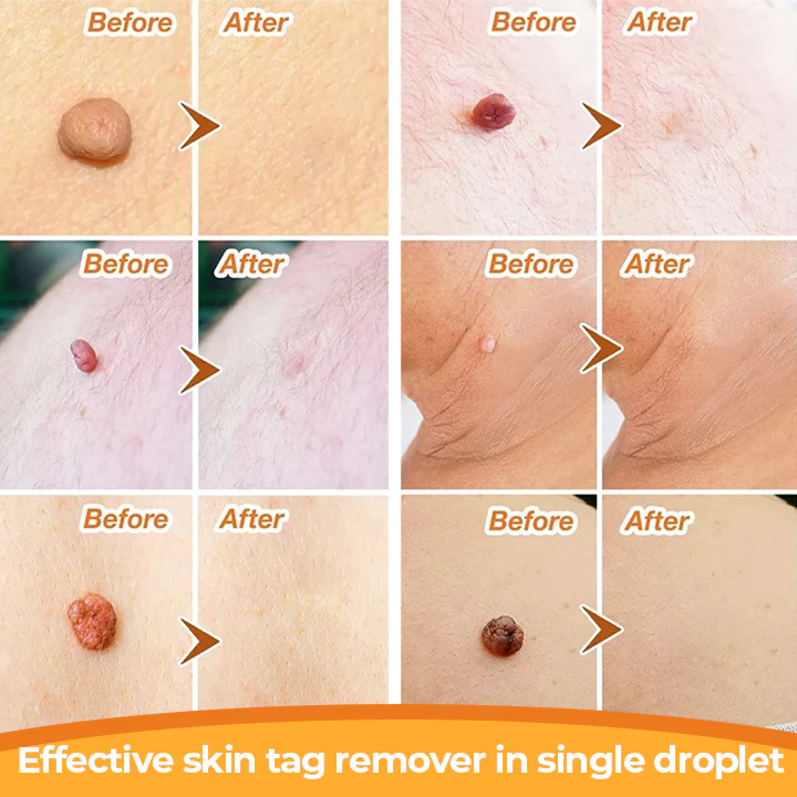 DR. Reilly Skin Tag Remover