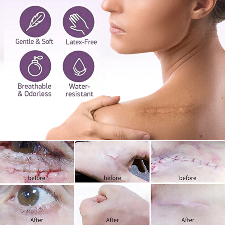 BIOCLEAR Silicone Scar Reduction Sheets