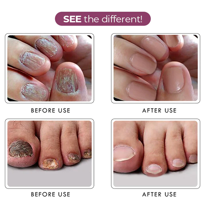 RxCARE Ginger Nail Treatment Essence