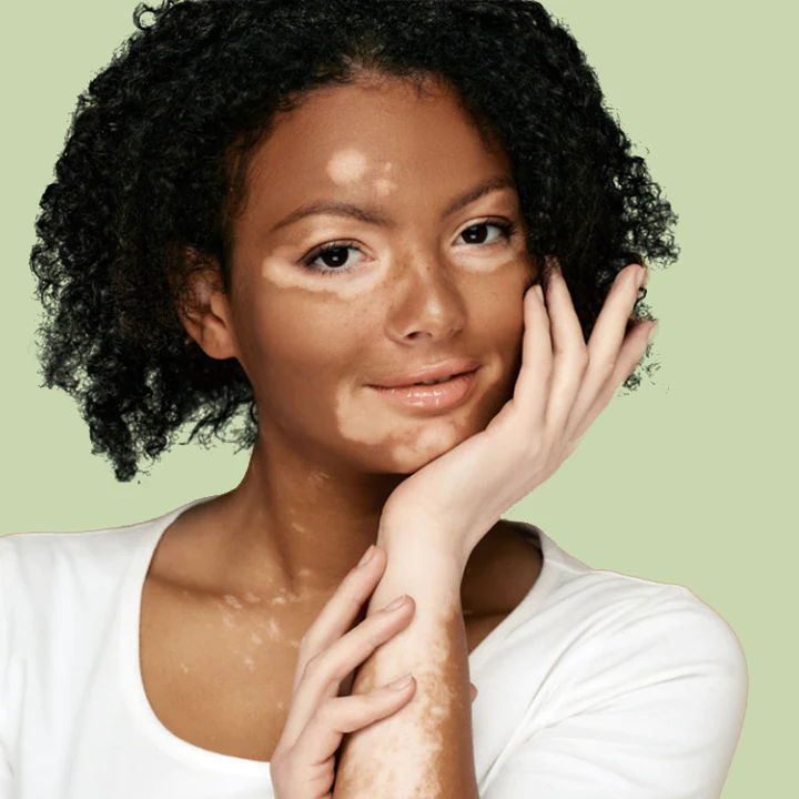 MEDix Vitiligo Treatment Oil