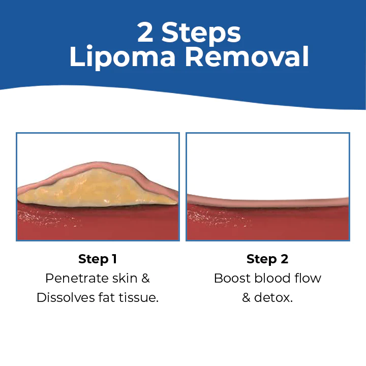 MEDix Lipoma Removal Cream