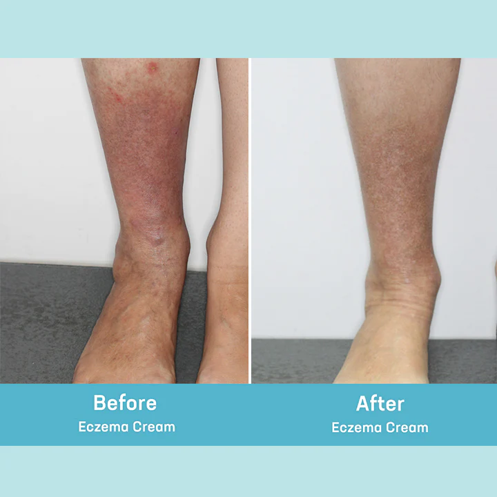 MEDix Eczema Treatment Spray