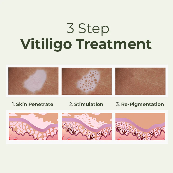 MEDix Vitiligo Treatment Oil