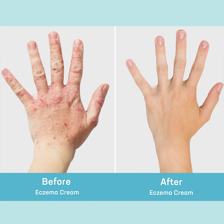 MEDix Eczema Treatment Spray