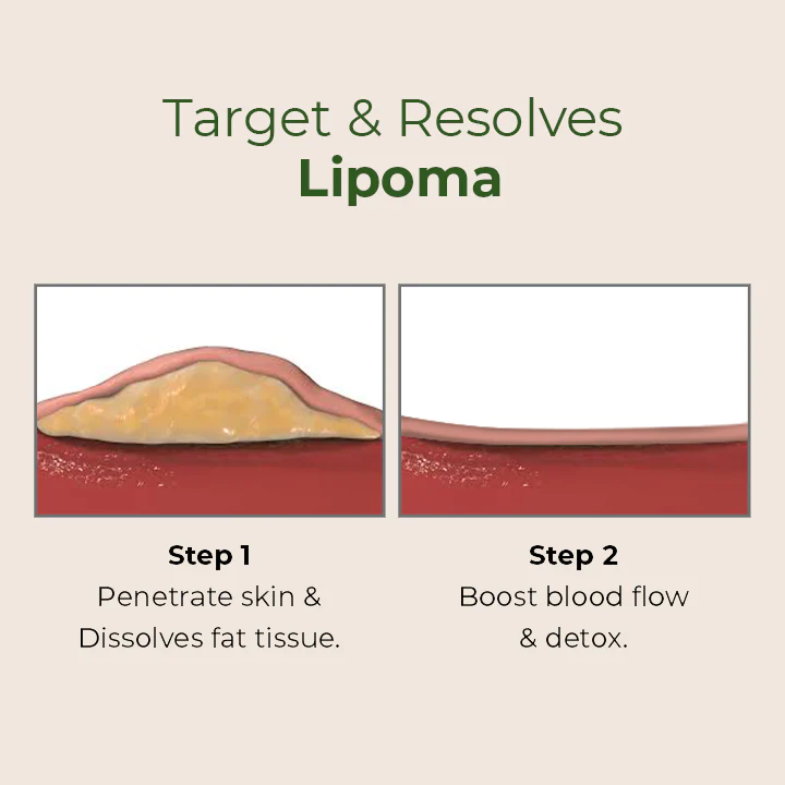 MEDix Lipoma Removal Patch