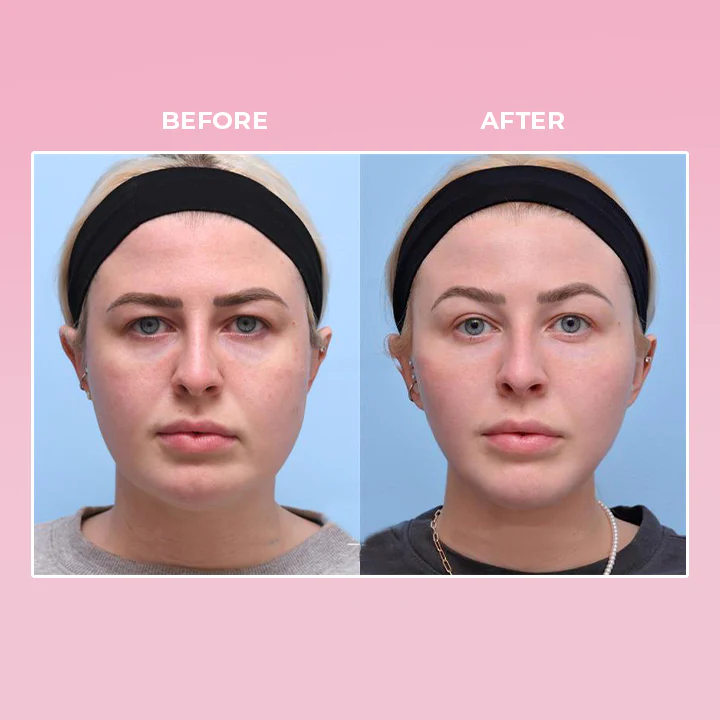 Oveallgo PRO Double Chin Removal V-Face Suction Trainer