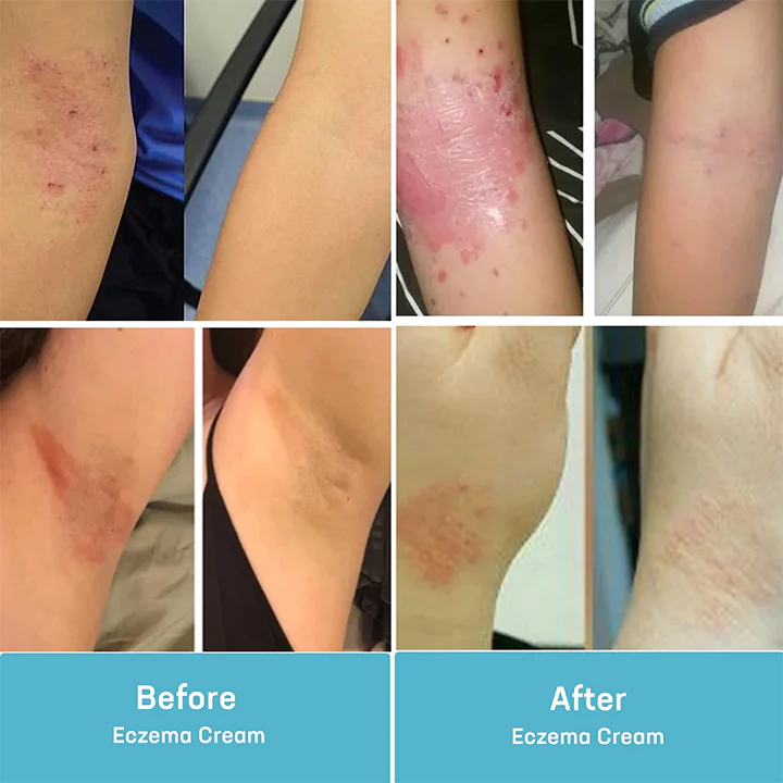 MEDix Eczema Treatment Spray