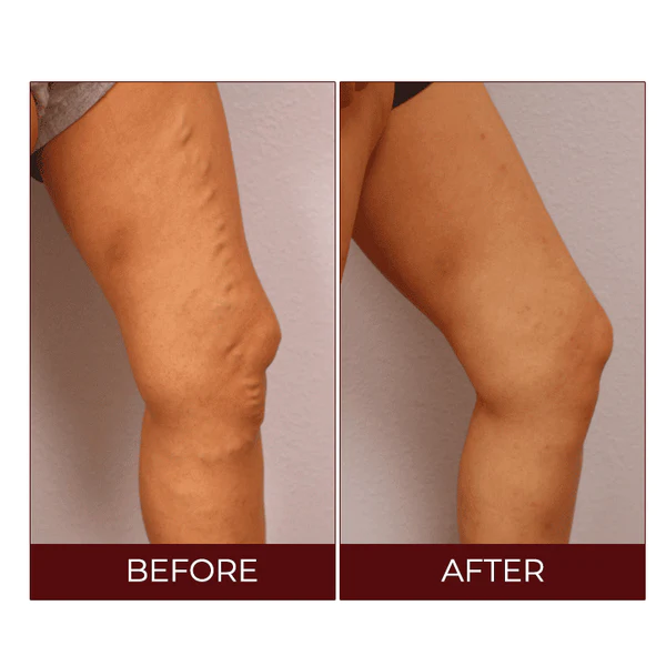 AUQUEST Varicose Veins Relief Cream