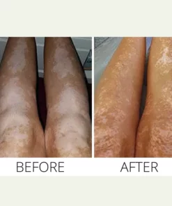 MEDix Vitiligo Treatment Oil