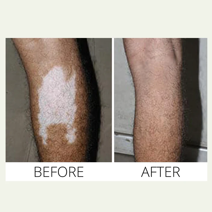 MEDix Vitiligo Treatment Oil