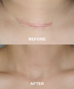 BIOCLEAR Silicone Scar Reduction Sheets