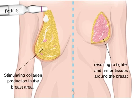 PerkUp Breast Enhancing Ampoule