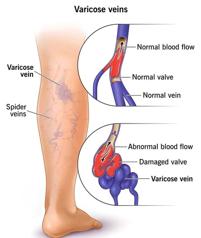 LymphCare VaricoseVeins Treatment Cream