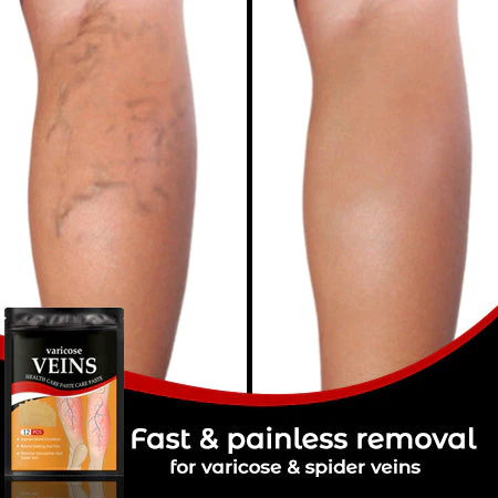 Breakss Varicose Vein Ointment Patch