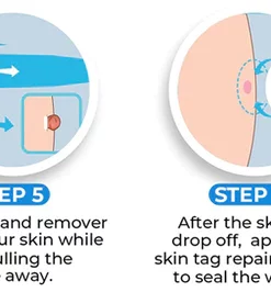 Skin Tag Remover Kit