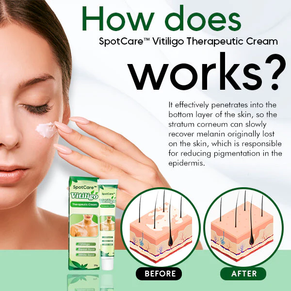 SpotCare Vitiligo Therapeutic Cream