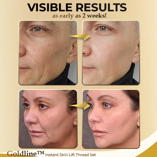 Goldline Instant Skin Lift Thread Set