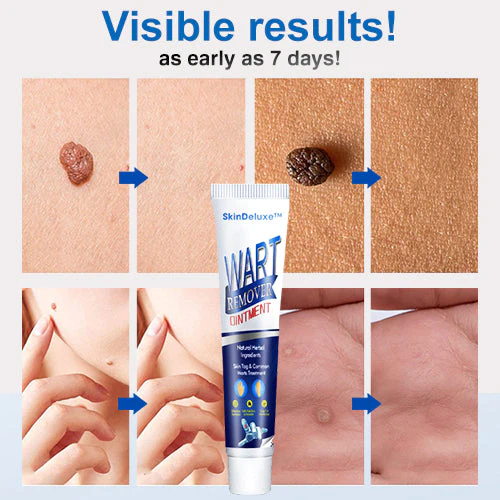 Skin Deluxe Wart Removal Ointment