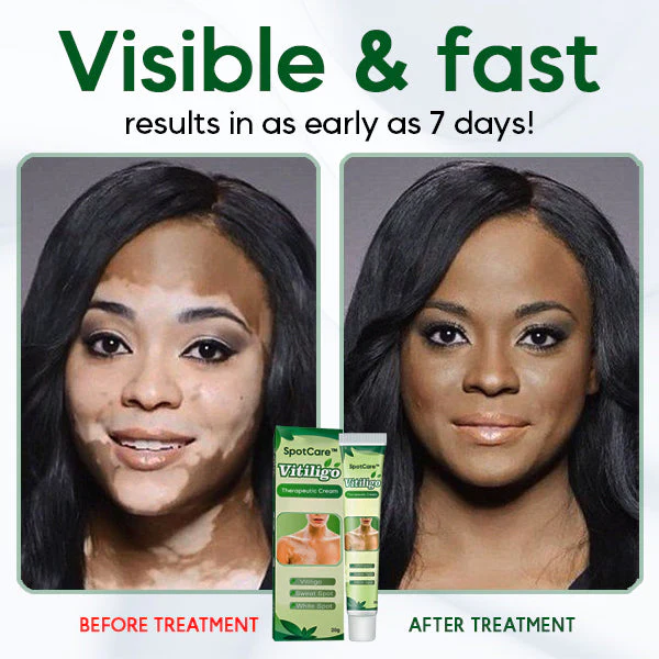 SpotCare Vitiligo Therapeutic Cream