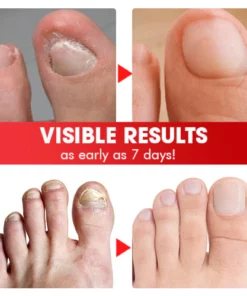 Nailcare Ingrown Toe Nail Drops