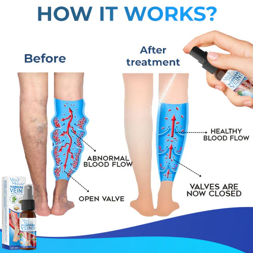 Veinhealing Varicose Veins Treatment Spray