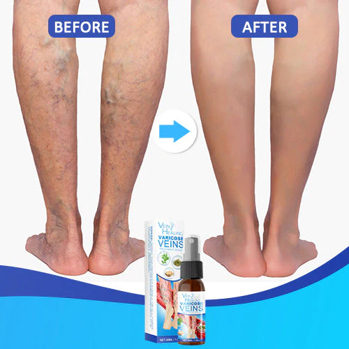 Veinhealing Varicose Veins Treatment Spray