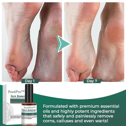 FootPro Corn Removal Extra Strengthen GelLimited time discount  last day