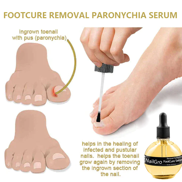 NailGro FootCure Removal Paronychia Serum