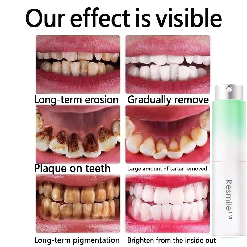 Resmile Pure Herbal Mouth Spray (Mouth cleaning and tooth regeneration, also for bad breath and dental caries)