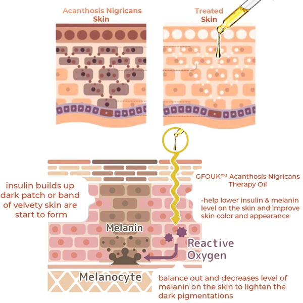 GFOUK Acanthosis Nigricans Therapy Oil