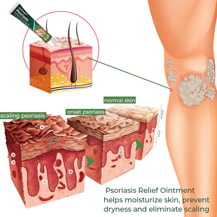 Kolmax Psoriasis Soothing Ointment