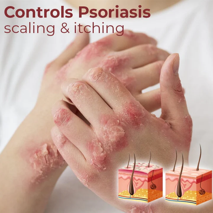 Kolmax Psoriasis Relief Spray