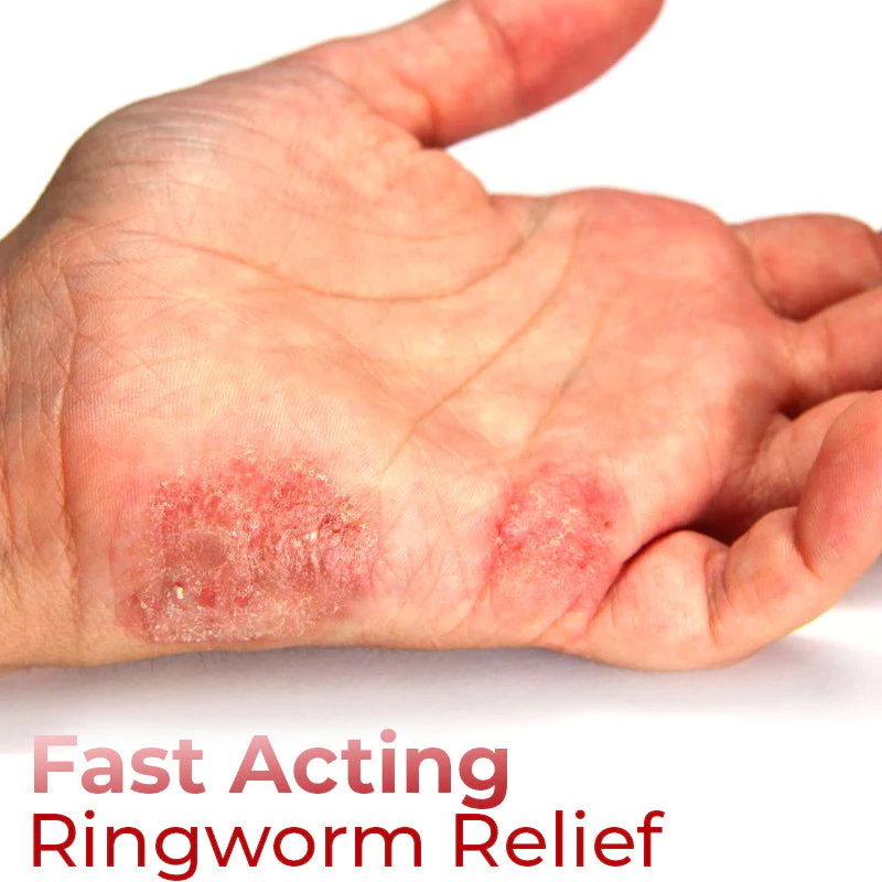 GFOUK Hand Ringworm Relief Spray