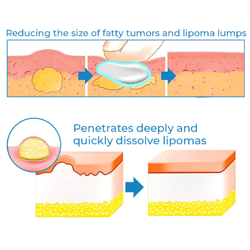 CurSkin Lipoma Treatment Ointment