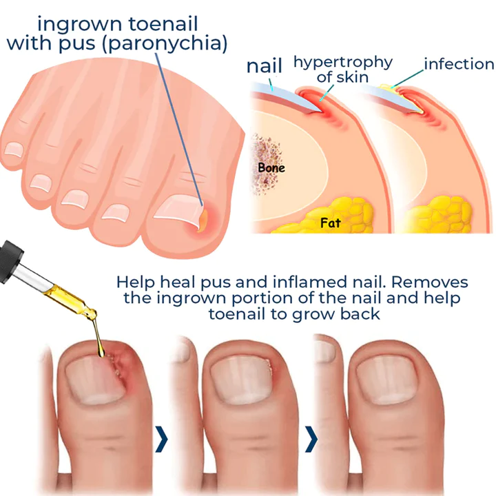 German ToenailPlus Anti Paronychia Relief Oil