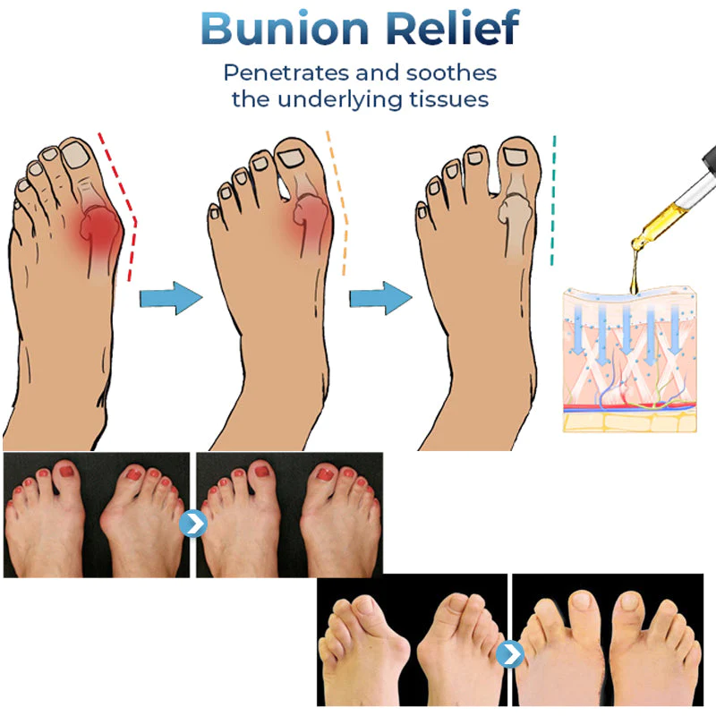 GFOUK German Bunion Relief Oil