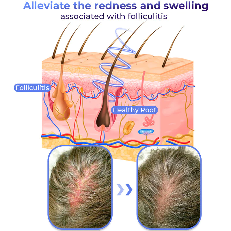 GFOUK Anti Folliculitis Therapy Oil