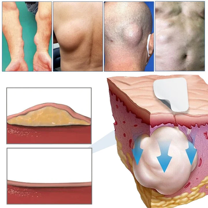 KoMedi Lipoma Relief Patch