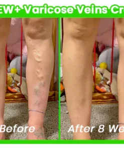 RENEW+ Varicose Veins Cream